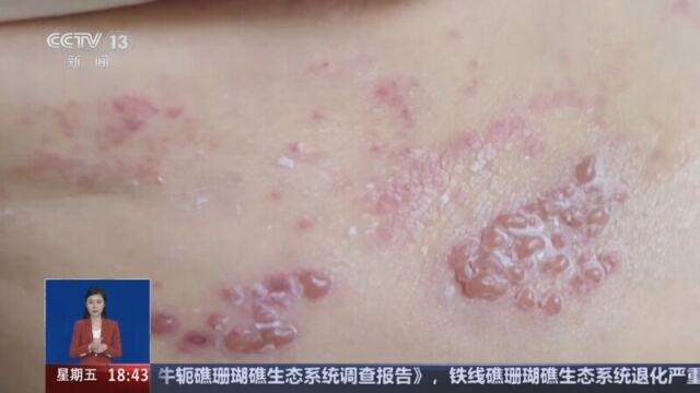 皰疹，了解、預(yù)防與治療，皰疹，全面解析、預(yù)防與治療方法