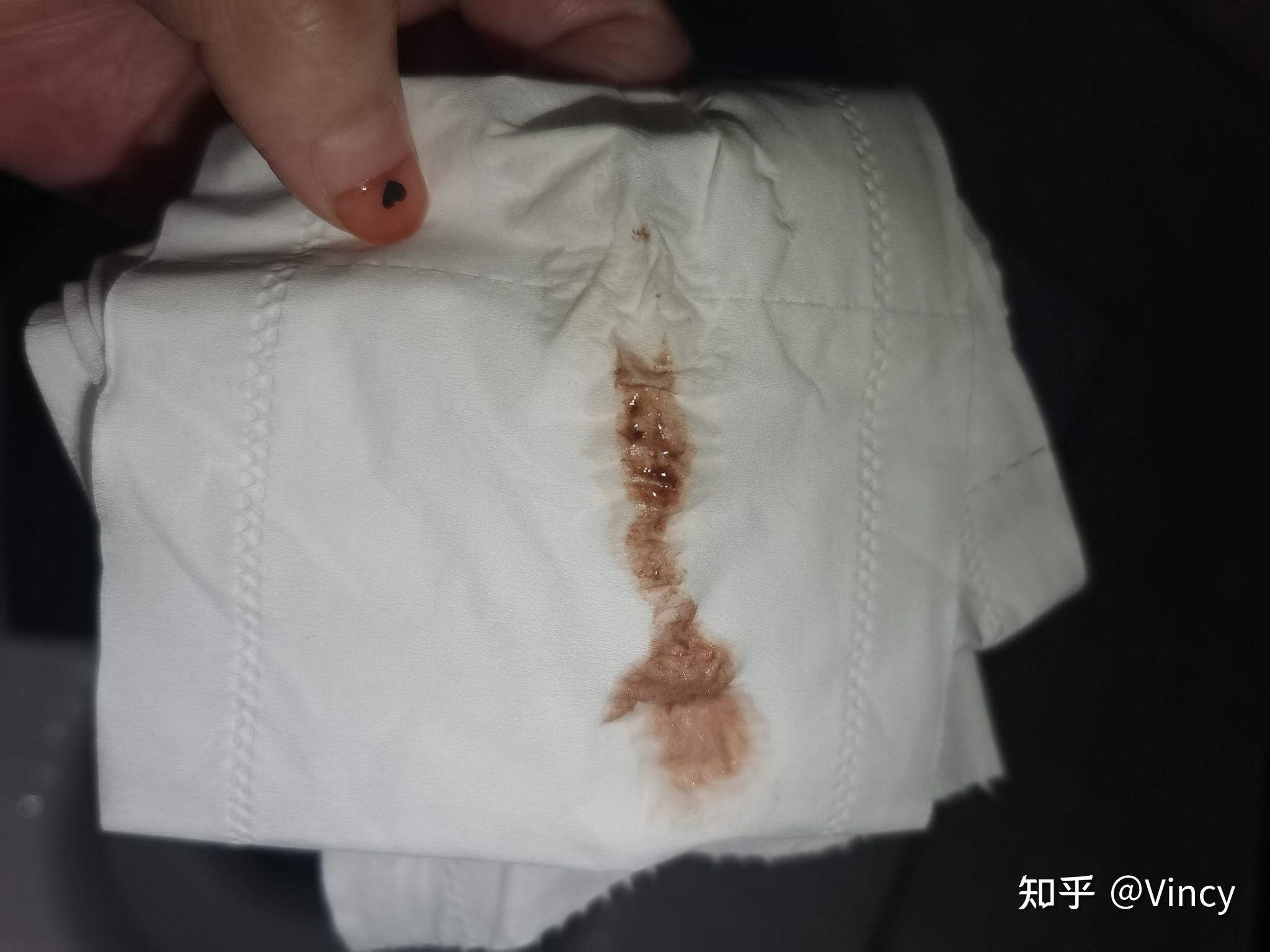 姨媽不流血只有褐色的東西，原因解析與關(guān)注，姨媽不流血只有褐色物，原因分析及關(guān)注要點(diǎn)