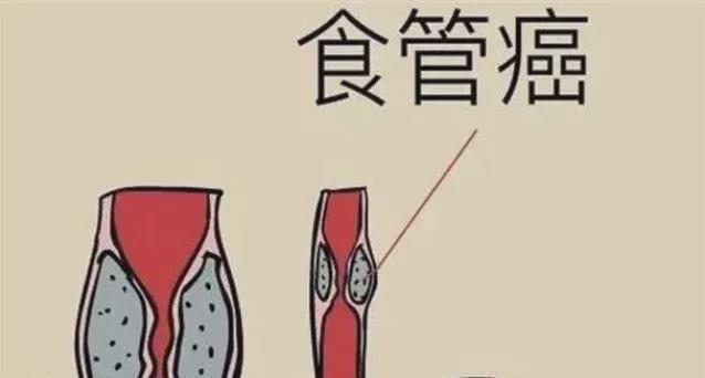 食道炎與食道癌的區(qū)別